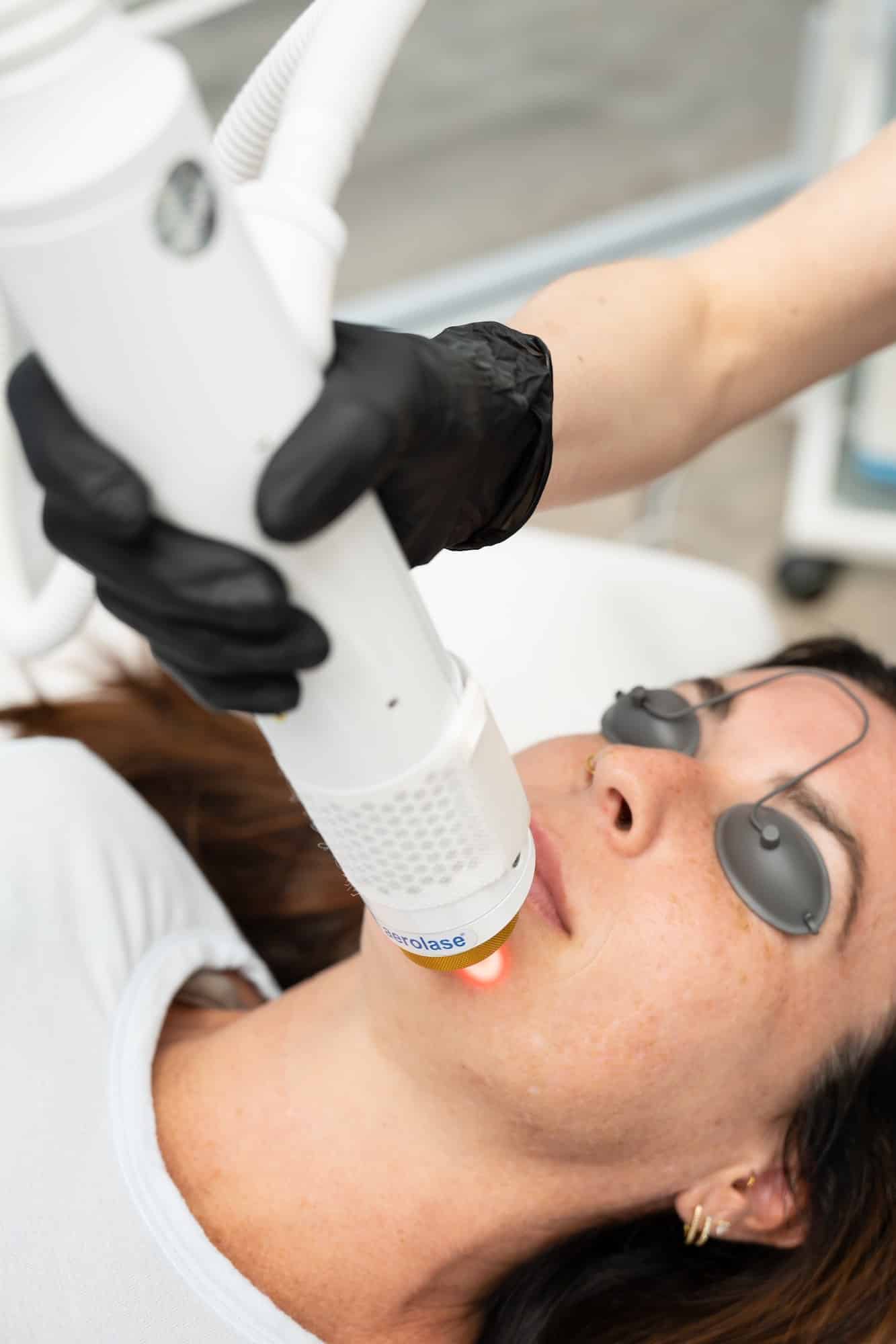Laser Treatments - SG Aesthetics & Wellness Laser Treatments
