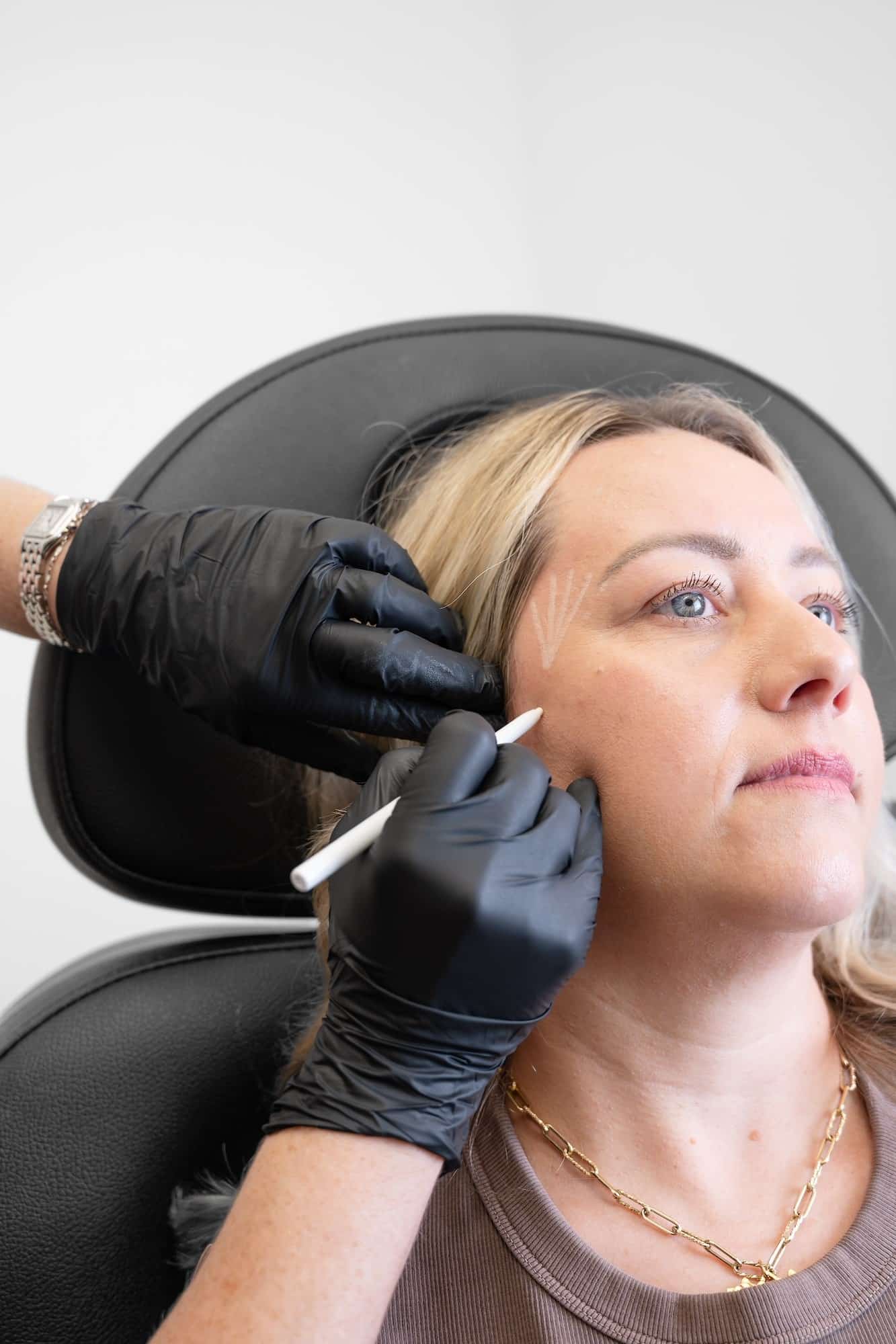 Juvederm filler treatment at SG Aesthetics & Wellness in Charleston, SC