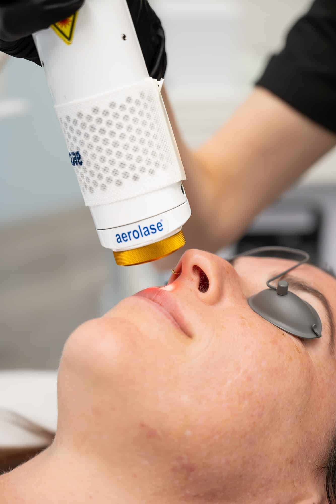 Laser skin resurfacing at SG Aesthetics & Wellness in Charleston SC