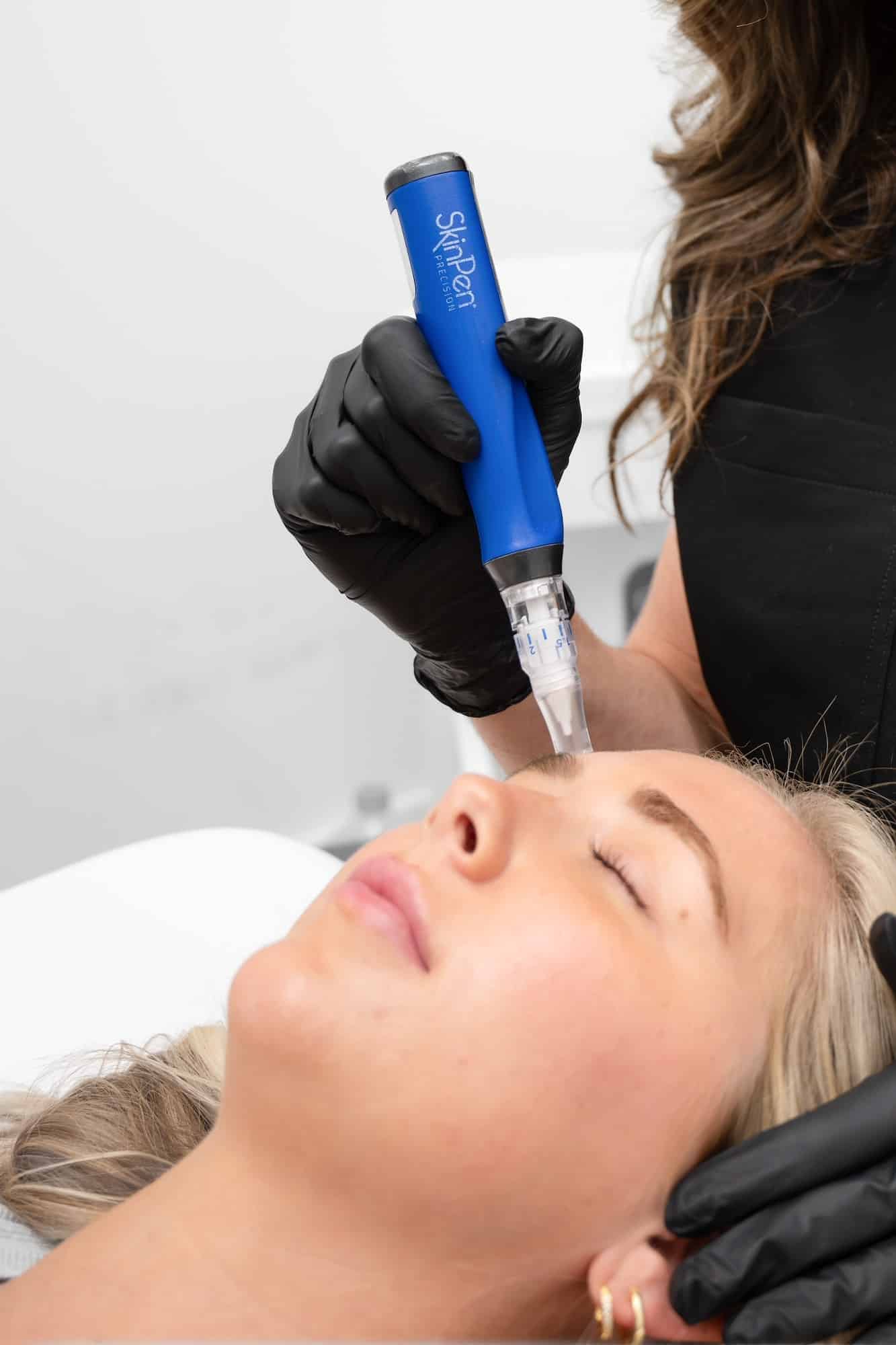 Microneedling treatment at SG Aesthetics & Wellness in Charleston SC