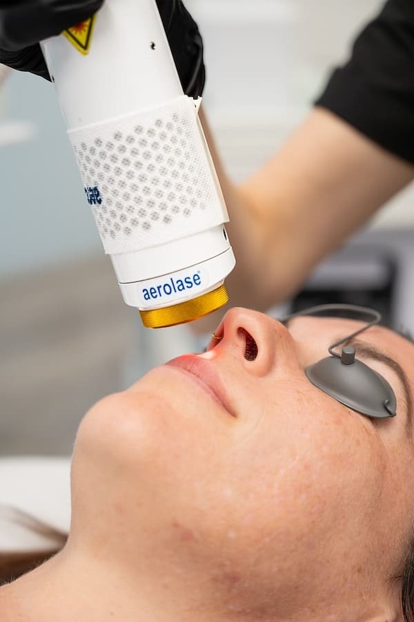 Aerolase Era laser resurfacing at SG Aesthetics in Charleston SC