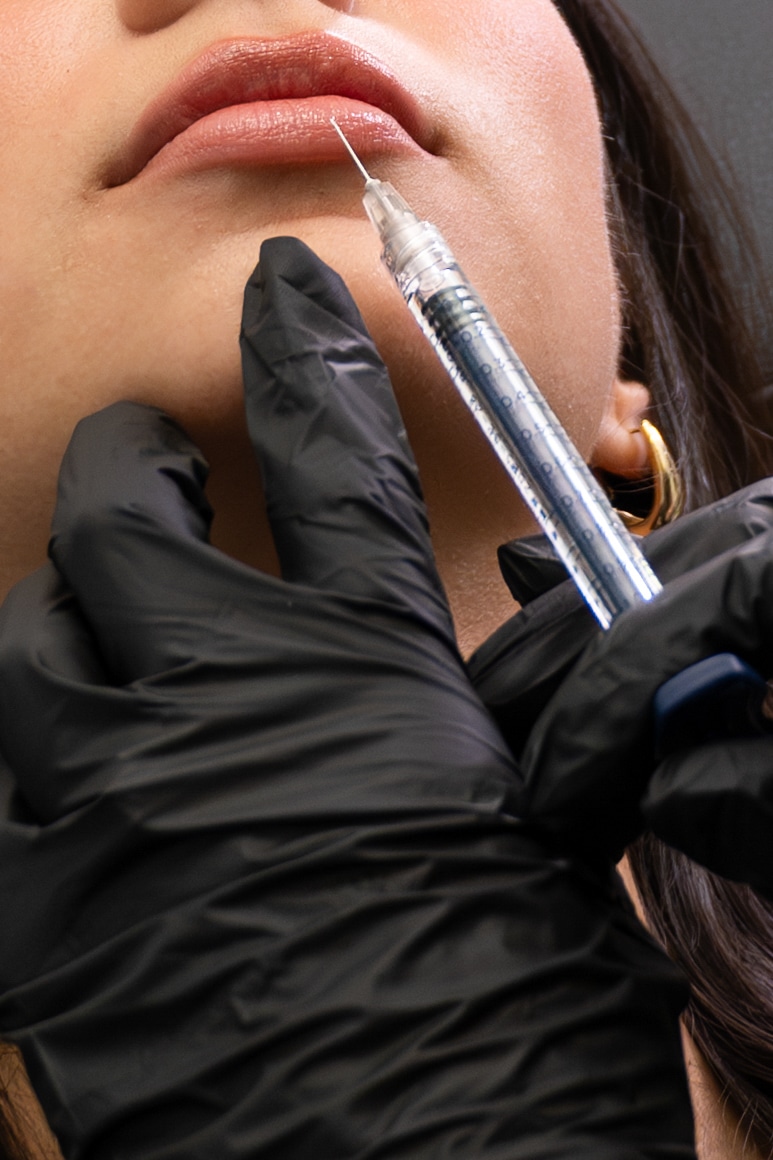 Versa filler - SG Aesthetics & Wellness